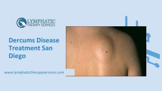 Dercums Disease Treatment San Diego