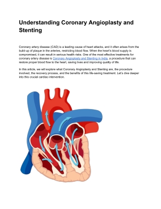 Understanding Coronary Angioplasty and Stenting