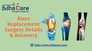 Knee Replacement Surgery Details & Recovery (1)