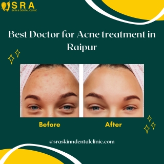 Best Doctor for Acne treatment in Raipur