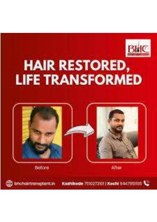 Best Hair Transplant Clinic in Kerala – BHC Hair Restoration