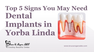 Top 5 Signs You May Need Dental Implants in Yorba Linda