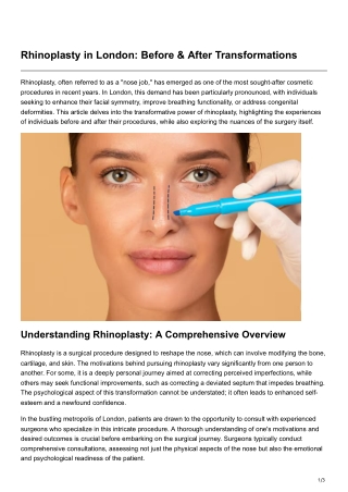 Rhinoplasty in London Before After Transformations