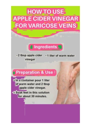How to cure varicose veins with vinegar