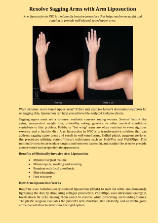 Resolve Sagging Arms with Arm Liposuction