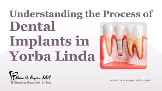 Understanding the Process of Dental Implants in Yorba Linda