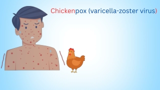 Chickenpox