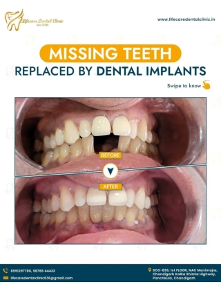 Missing Teeth Replaced by Best Dental Implantologist in Panchkula - Life Care Dental Clinic
