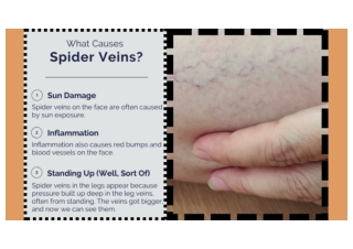 How to cover spider veins in legs?