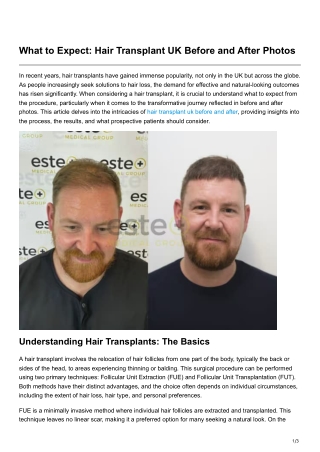 What to Expect Hair Transplant UK Before and After Photos