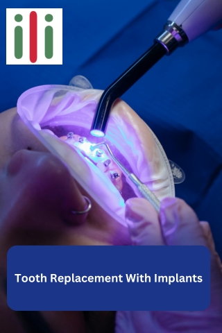 Tooth Replacement With Implants