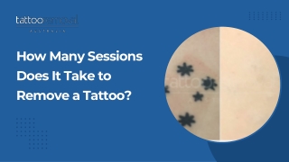 How Many Sessions Does It Take to Remove a Tattoo