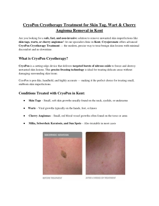 CryoPen Cryotherapy Treatment for Skin Tag, Wart & Cherry Angioma Removal in Kent