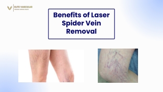 Benefits of Laser Spider Vein Removal