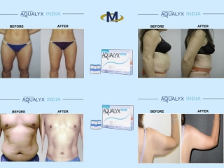 Aqualyx non-surgical fat reduction treatment