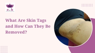 What Are Skin Tags and How Can They Be Removed