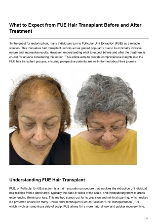 What to Expect from FUE Hair Transplant Before and After Treatment
