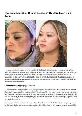 Hyperpigmentation Clinics Leicester Restore Even Skin Tone