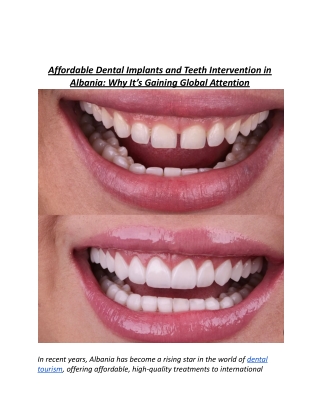 Affordable Dental Implants and Teeth Intervention in Albania