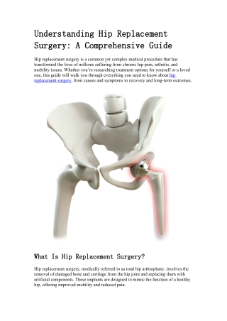 Guide to Understanding Hip Replacement Surgery