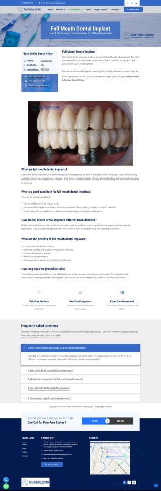 Full Mouth Dental Implant in Koramangala - Best Smiles Dental