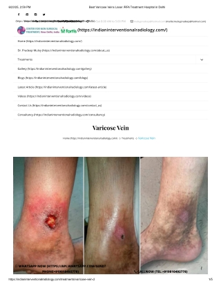 varicose veins treatment in delhi