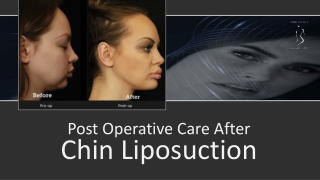 Post Operative Care After Chin Liposuction