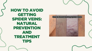 How to Avoid Getting Spider Veins: Natural Prevention and Treatment Tips