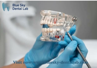 Durable Malone Bridge Frames by Blue Sky Dental Lab – Precision Fit