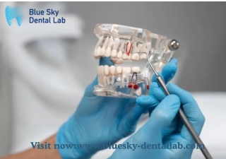 Custom Malo Bridge Solutions | Blue Sky Dental Lab Precision
