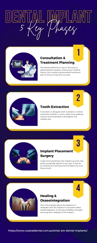 5 Key Phases of a Dental Implant