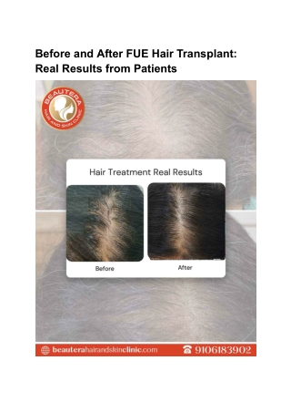 Before and After FUE Hair Transplant: Real Results from Patients