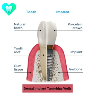 Dental implant Tunbridge Wells