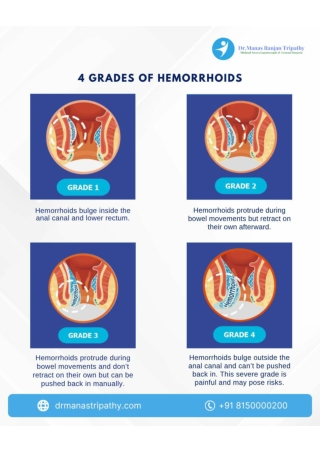 Understand the 4 grades of hemorrhoids_Dr Manas_piles doctor in bangalore