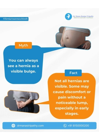 Myth vs Fact Hernia Awareness_Dr Manas_Proctologist in HSR Layout