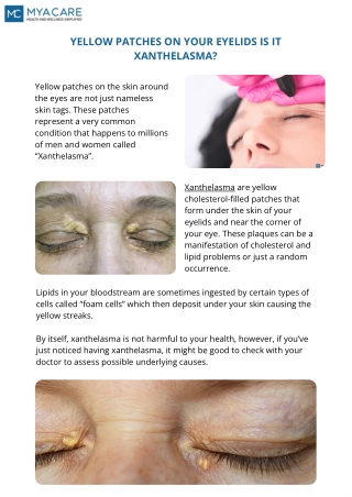 YELLOW PATCHES ON YOUR EYELIDS IS IT XANTHELASMA?