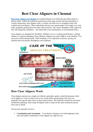 Best Clear Aligners in Chennai
