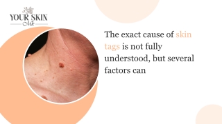 The exact cause of skin tags is not fully understood, but several factors can