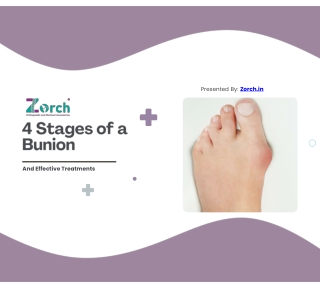 4 Stages of a Bunion
