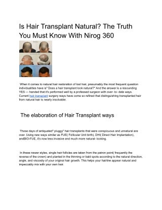 Is Hair Transplant Natural? The Truth You Must Know With Nirog 360