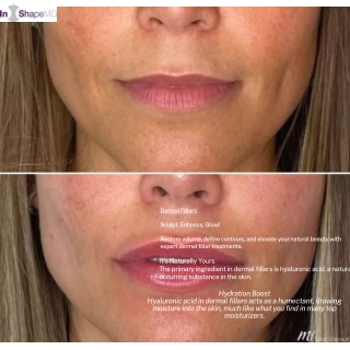 Dermal Filler Experts: Sculpt, Smooth & Glow