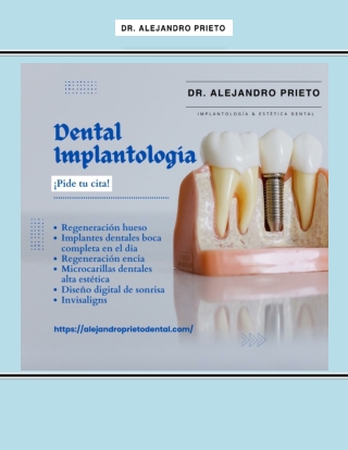 Prótesis Fijas Sobre Implantes