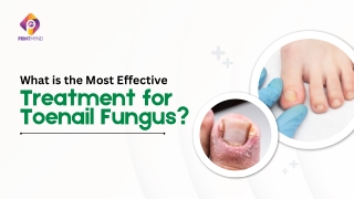 What is the Most Effective Treatment for Toenail Fungus?