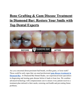 Bone Grafting & Gum Disease Treatment in Diamond Bar_ Restore Your Smile with Top Dental Experts