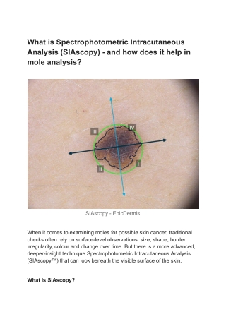 What is Spectrophotometric Intracutaneous Analysis (SIAscopy) - and how does it help in mole analysis