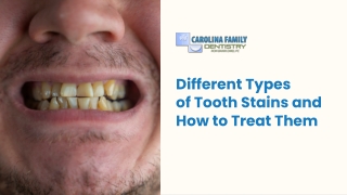 Expert Guide to Identifying and Treating Stubborn Tooth Stains Now