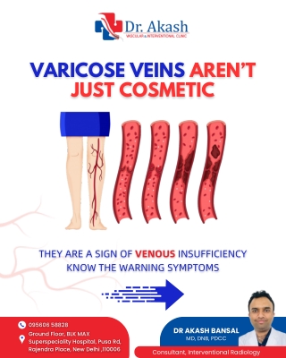 Varicose Veins Warnings: When to Consult a Vascular Specialist | Dr Akash Bansal